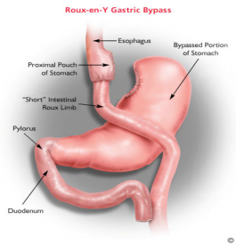 gastric bypass hickory